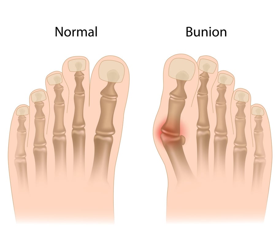 Bunion