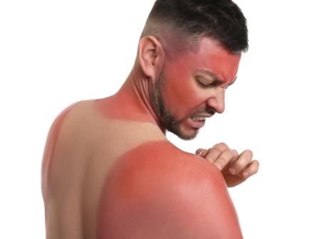 Luka Bakar Akibat Sengatan Matahari (Sunburn)