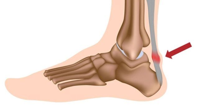 Tendinitis Achilles