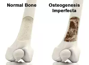 Osteogenesis Imperfecta