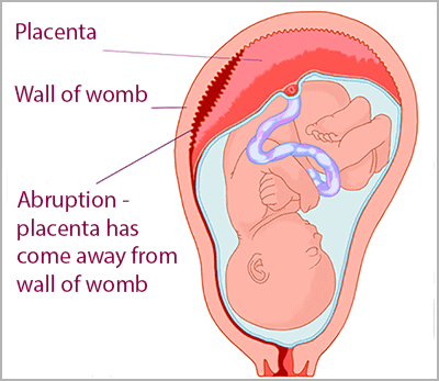 Solusio Plasenta