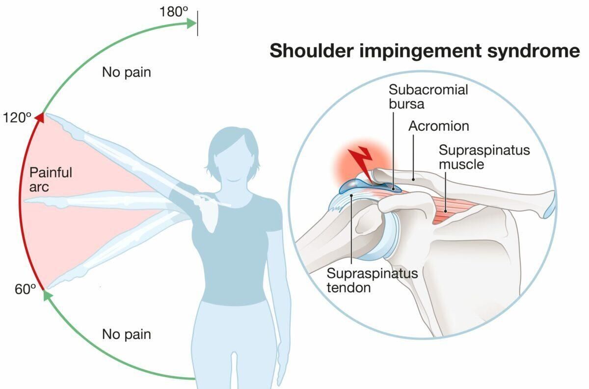 Sindroma Jepitan Bahu (Shoulder Impingement Syndrome)