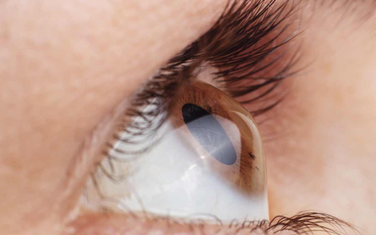 Keratoconus