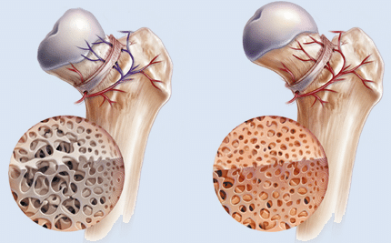 Osteonekrosis