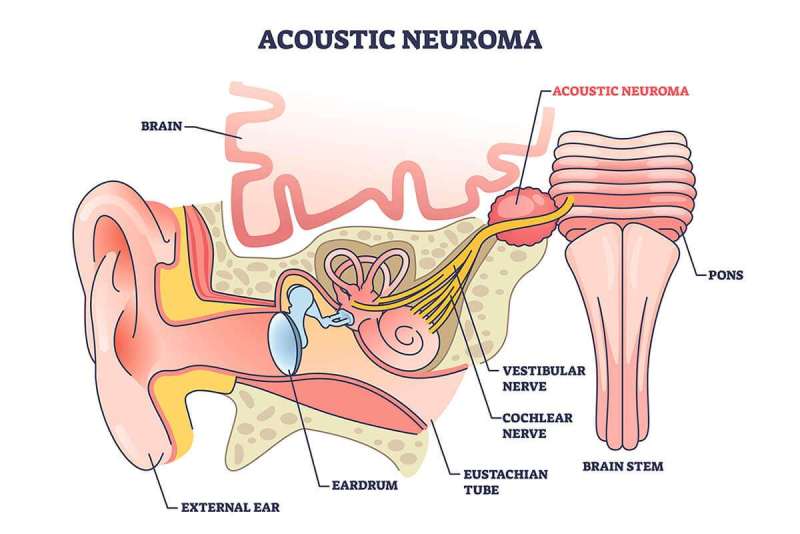 Neuroma Akustik