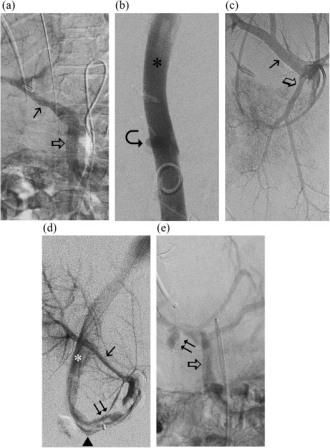 Splenoportografi