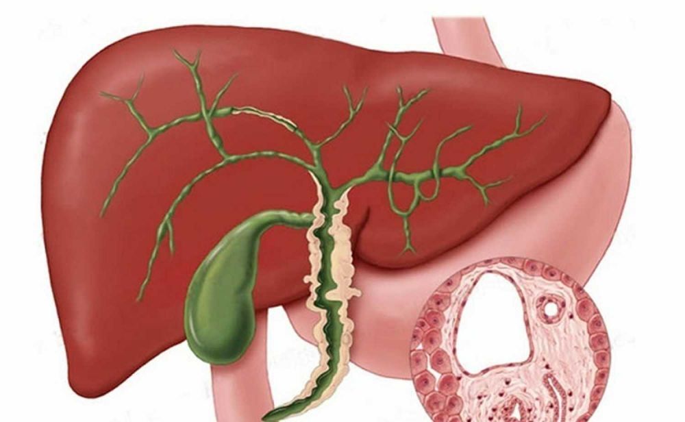 Kolangitis Sklerotik Primer