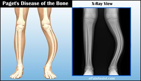 Penyakit Paget Pada Tulang (Osteitis Deformans)