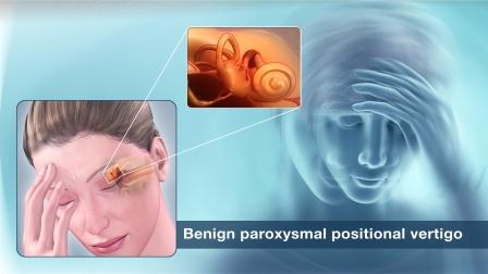 Benign Paroxysmal Positional Vertigo (BPPV)