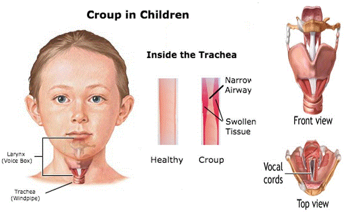 Croup