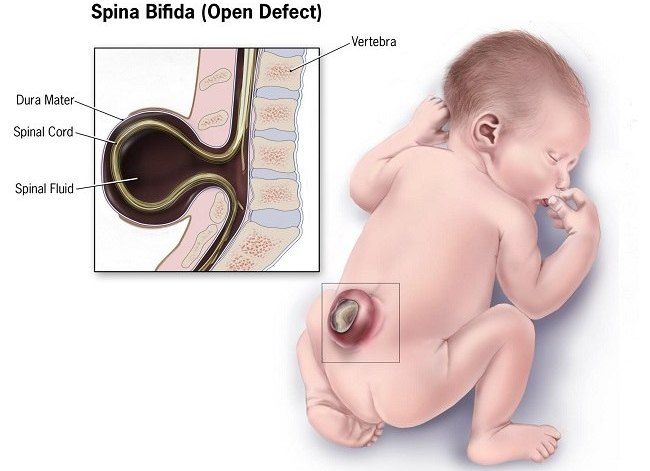 Spina Bifida