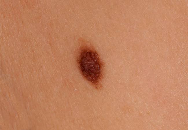 Melanoma