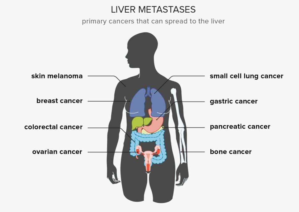 Kanker Hati Metastatik