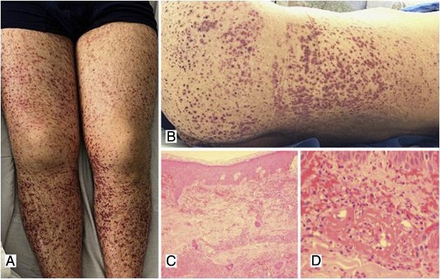 Purpura Alergika