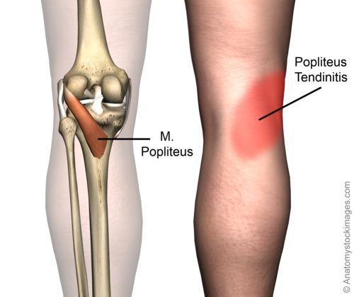 Tendinitis Poplitea