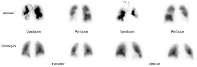 Scanning Ventilasi Paru-Paru