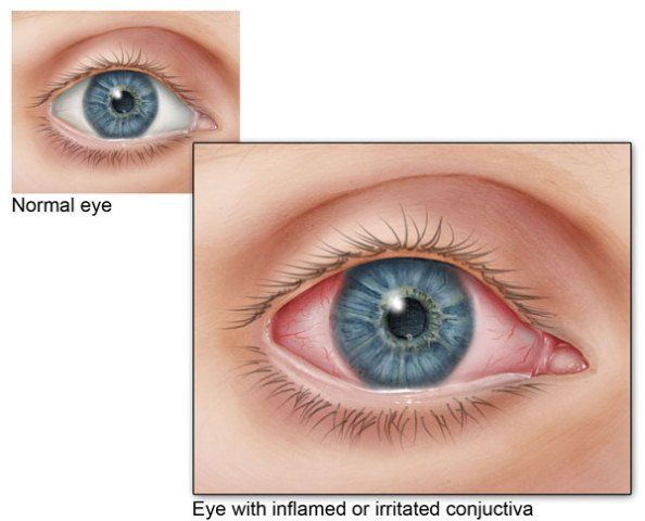 Konjungtivitis Alergika