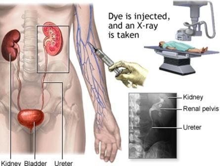 Pyelografi Intravena