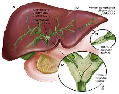 Tumor Saluran Empedu