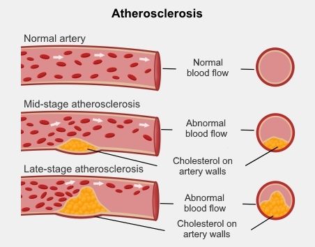 Aterosklerosis