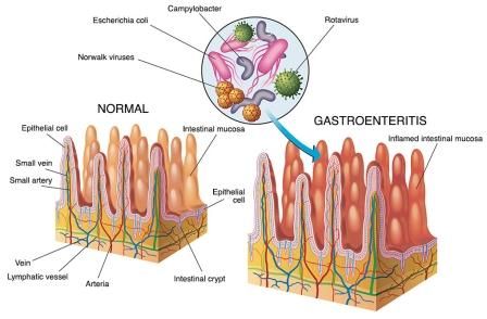 Gastroenteritis