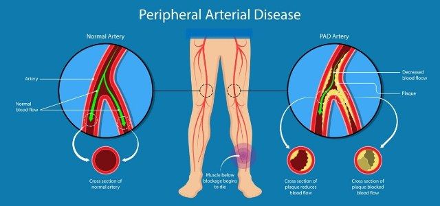 Penyakit Arteri Perifer