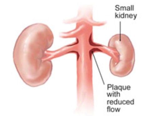 Sumbatan Arteri Renalis