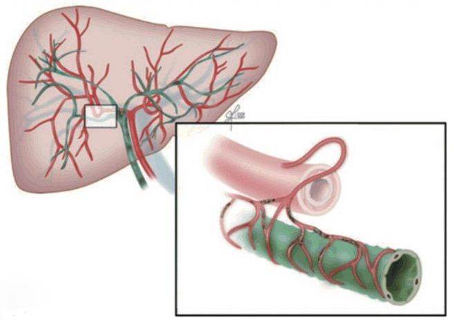 Ischemic Cholangiopathy