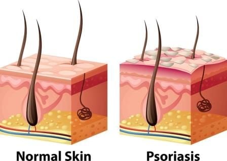 Jenis-Jenis Psoriasis