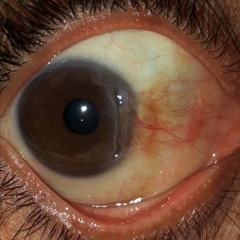 Keratitis Ulseratif Perifer