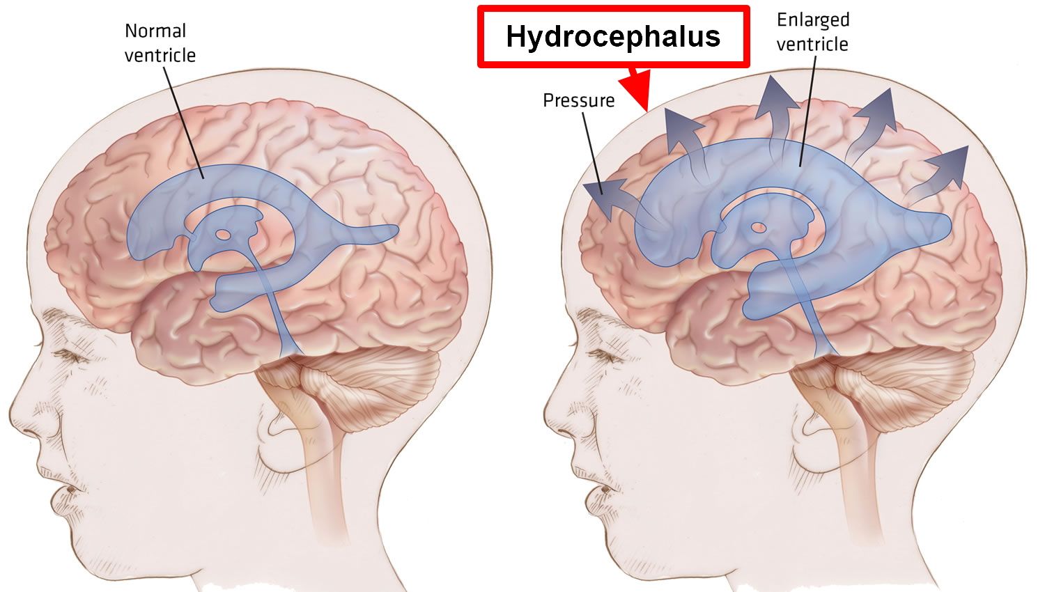 Hidrosefalus