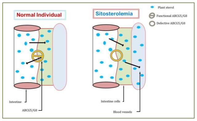 Sitosterolemi