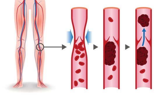 Trombosis Vena Dalam