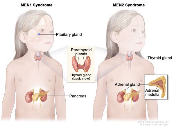 Sindroma Neoplasia Endokrin Multipel