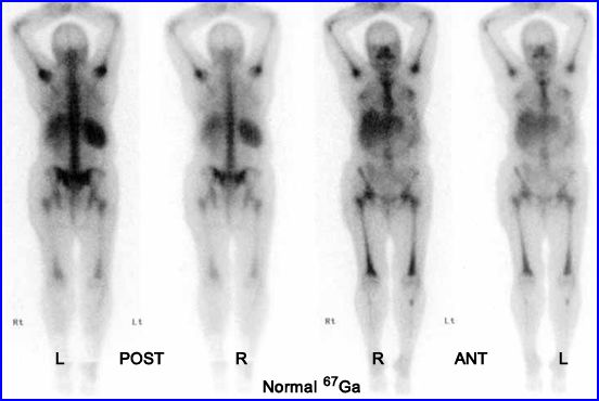 Scanning Galium pada Tubuh