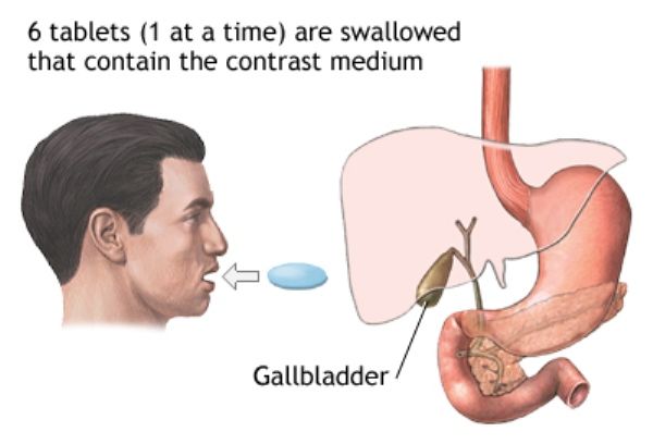 Kolesistografi Oral
