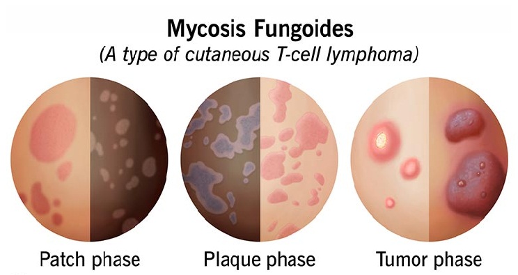 Mikosis Fungoides