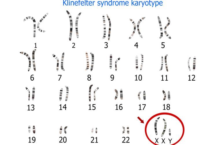 Sindroma Klinefelter