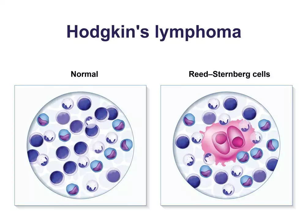 Penyakit Hodgkin (Limfoma Hodgkin)