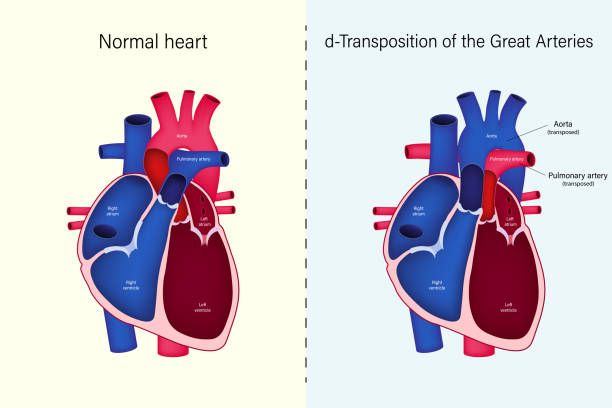 Transposisi Arteri Besar