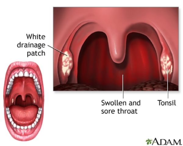 Faringitis (Radang Tenggorokan)