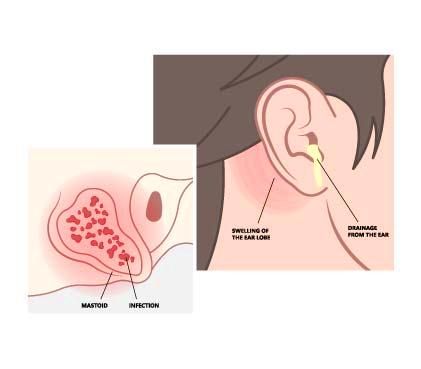 Mastoiditis Akut