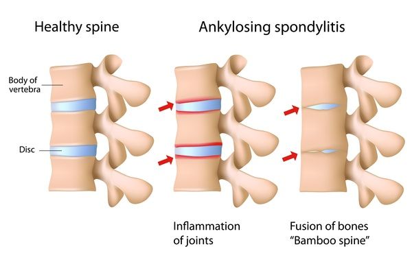 Spondiloarthropati