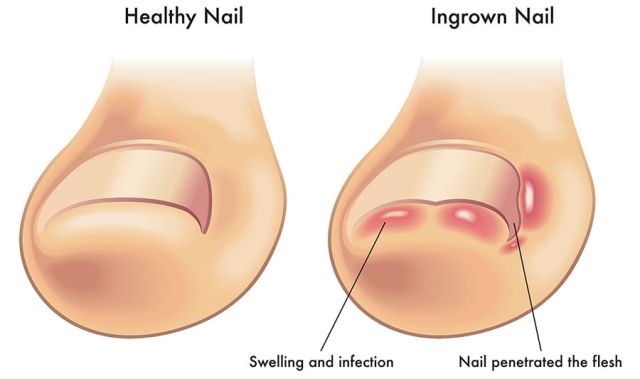 Kuku Jari Kaki Yang Tumbuh Ke Dalam (Ingrown Toenail)