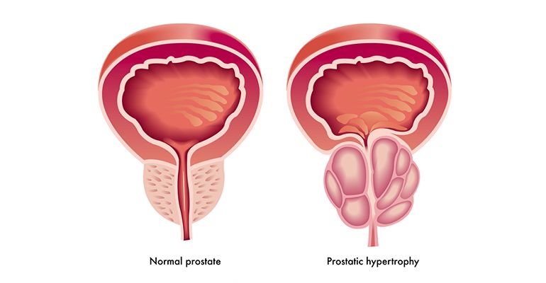 Pembesaran Prostat pada Orang Tua