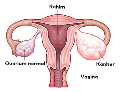 Kanker Indung Telur