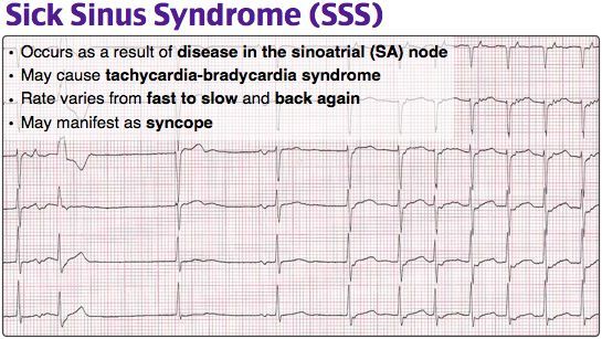 Sick Sinus Syndrome