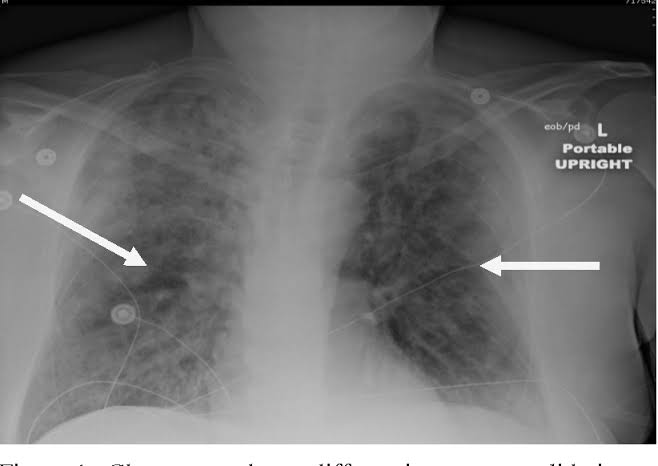 Pneumonia Eosinofilik