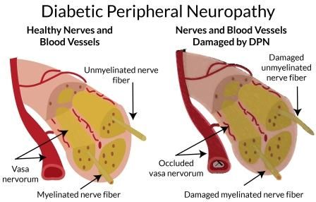 Neuropati Diabetik