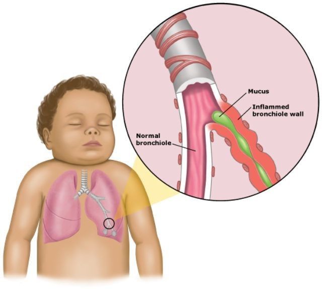 Bronkiolitis